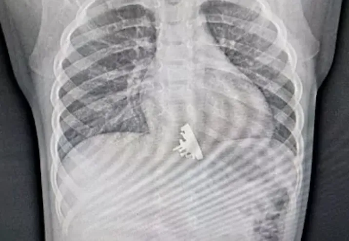 В Иркутске врачи спасли девочку, которая съела игрушечный крейсер "Аврора". Фото © Сайт ОГАУЗ ГИМДКБ