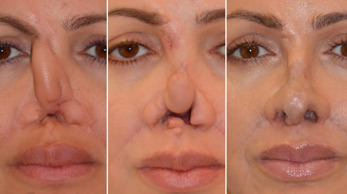 Результат операций на носу экс-супруги Аршавина. Фото © Telegram / Агапов Денис Генрихович