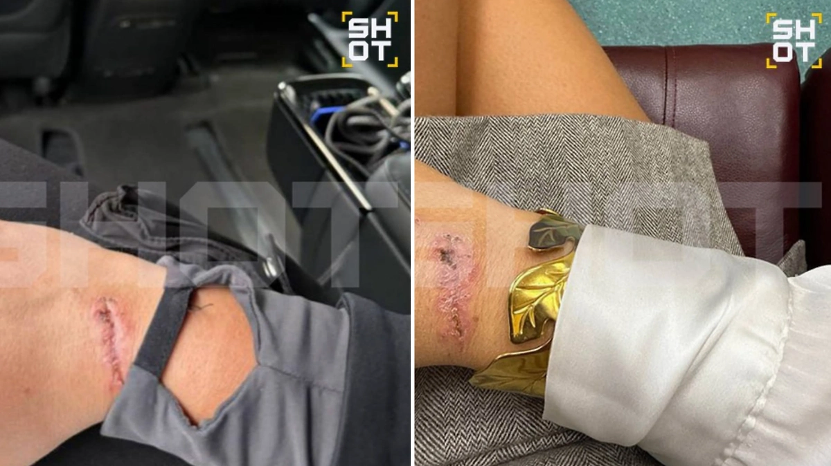 Укус акулы. Фото © Telegram / SHOT