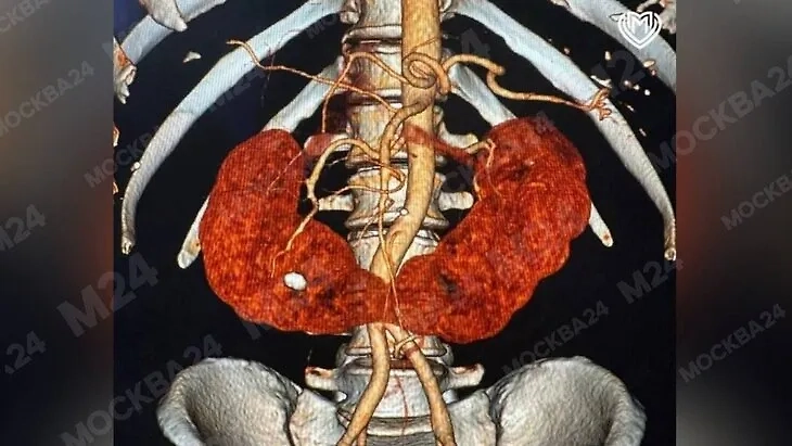 Подковообразная почка и камень. Фото © «Москва 24»