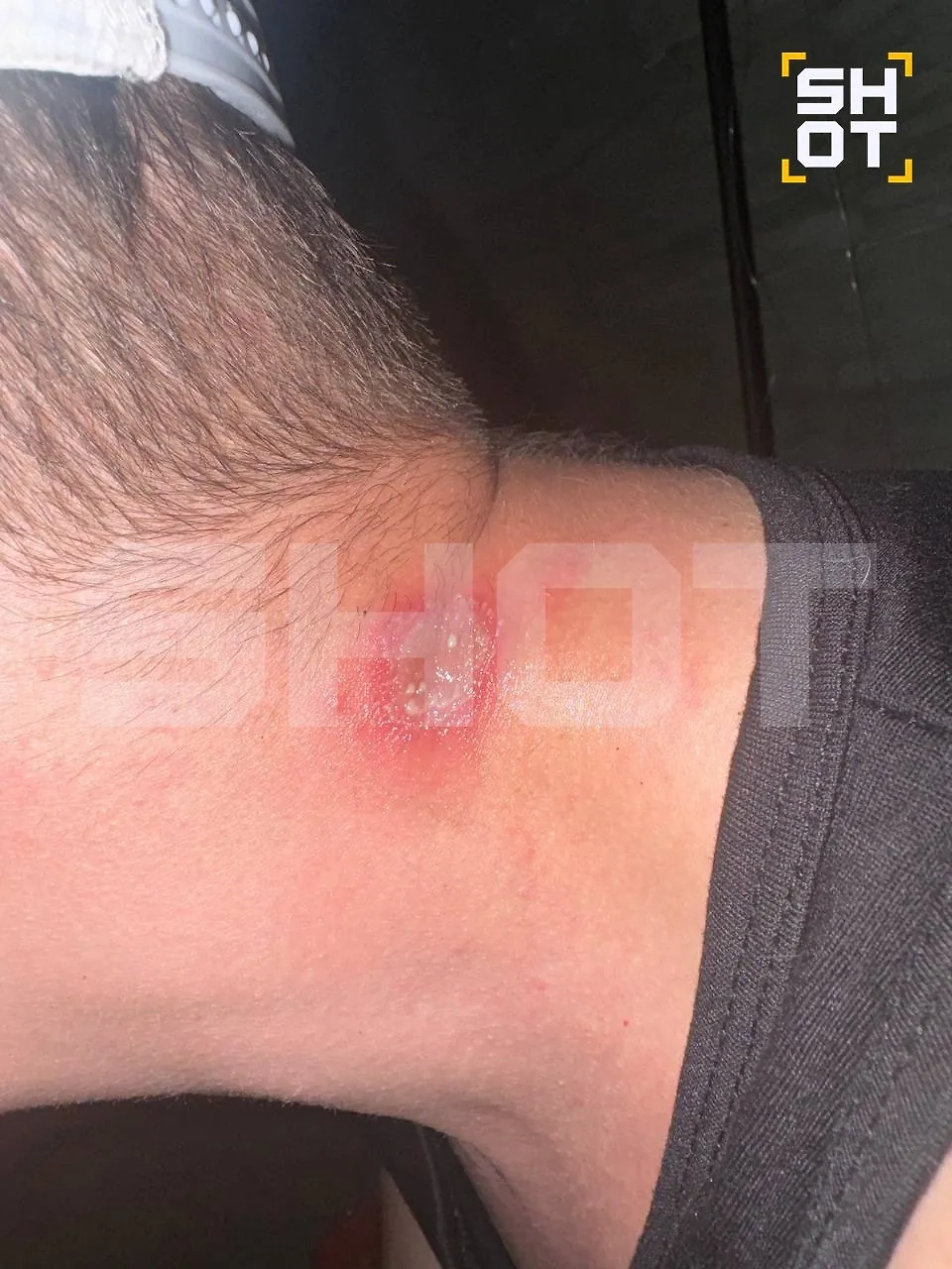 Ядовитые жуки атакуют туристов в отелях Вьетнама и Бали, оставляя жуткие ожоги. Фото © Telegram / SHOT