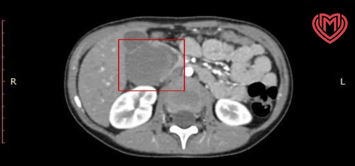 Гематома перекрыла просвет. Фото © Предоставлено Life.ru пресс-службой Депздрава Москвы