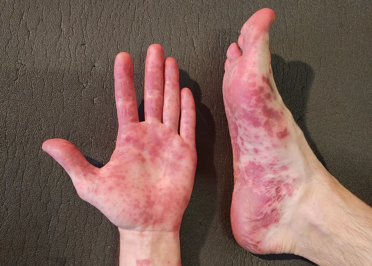 Турция снова пострадала, теперь от вируса Коксаки. Фото © Wikipedia / VORON SPb