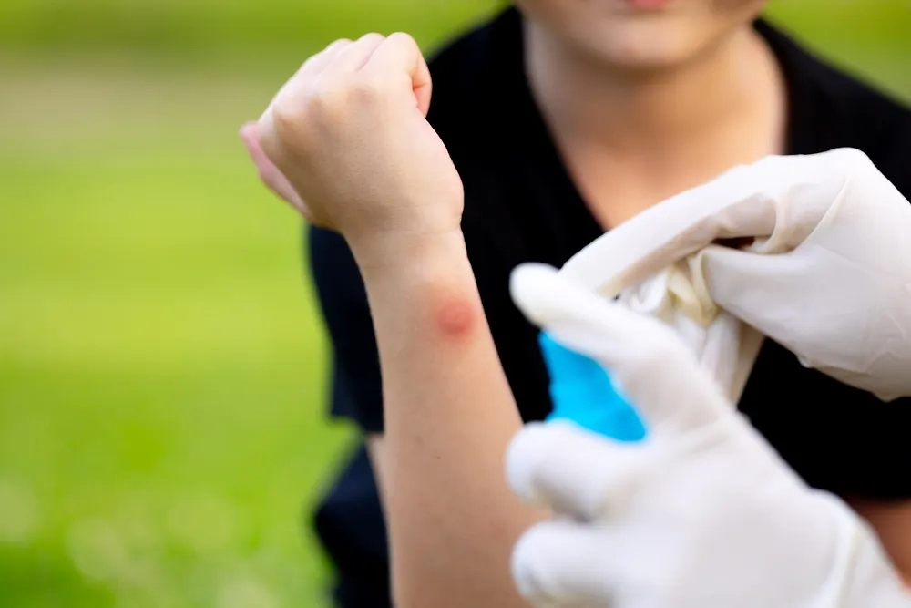 Первая помощь при укусе насекомого — как подобрать грамотное лечение? Фото © Shutterstock / FOTODOM / DocPhotos