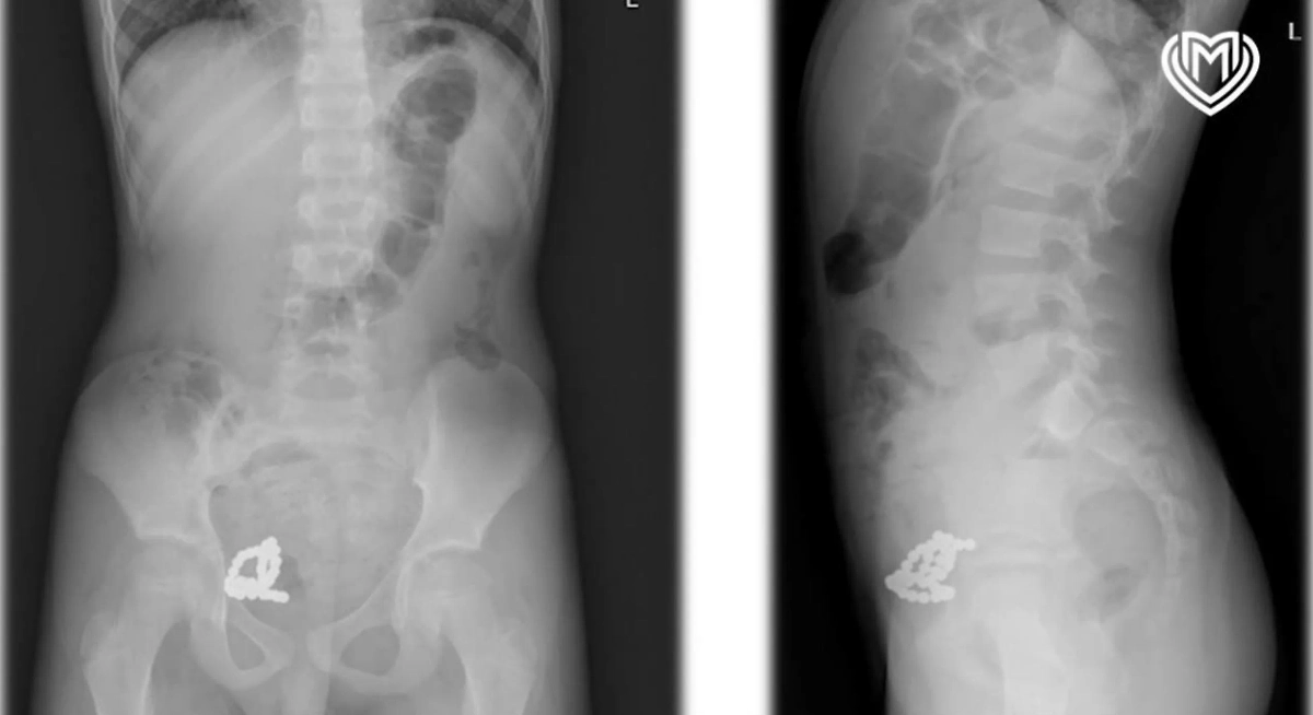 Рентген показал в организме мальчика целую коллекцию магнитиков. Фото © Предоставлено Life.ru