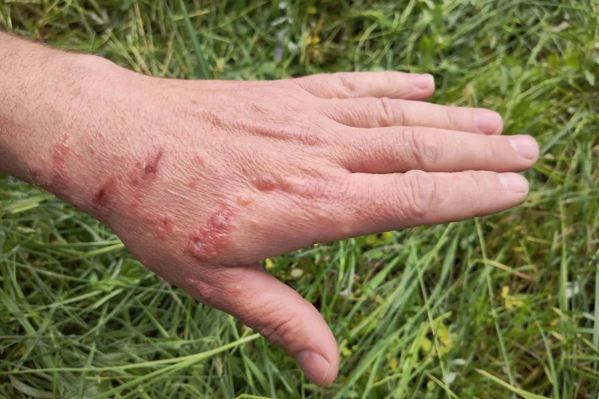 Первая помощь при ожоге от борщевика — промывание холодной водой. Фото © Shutterstock / FOTODOM / grisdee