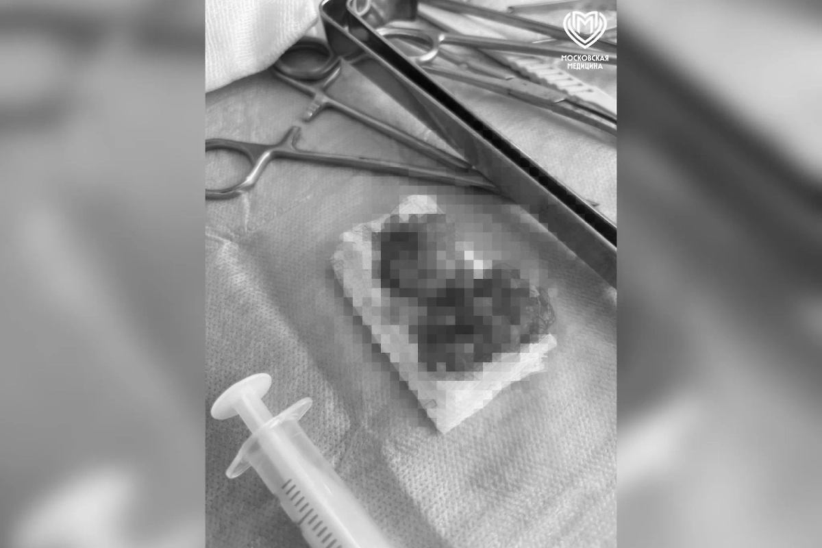 Вырезанное врачами новообразование. Фото © Telegram / Московская медицина
