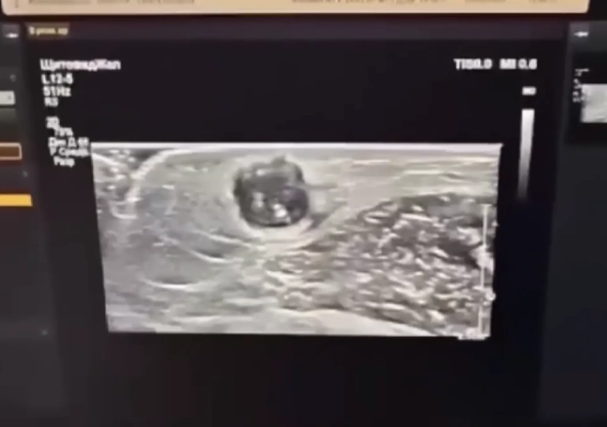 Новообразование. Фото © Telegram / Московская медицина