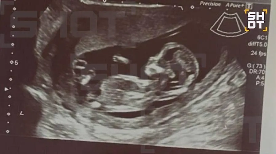 Россиянка лечилась от бесплодия, но забеременела после пластики груди. Фото © SHOT