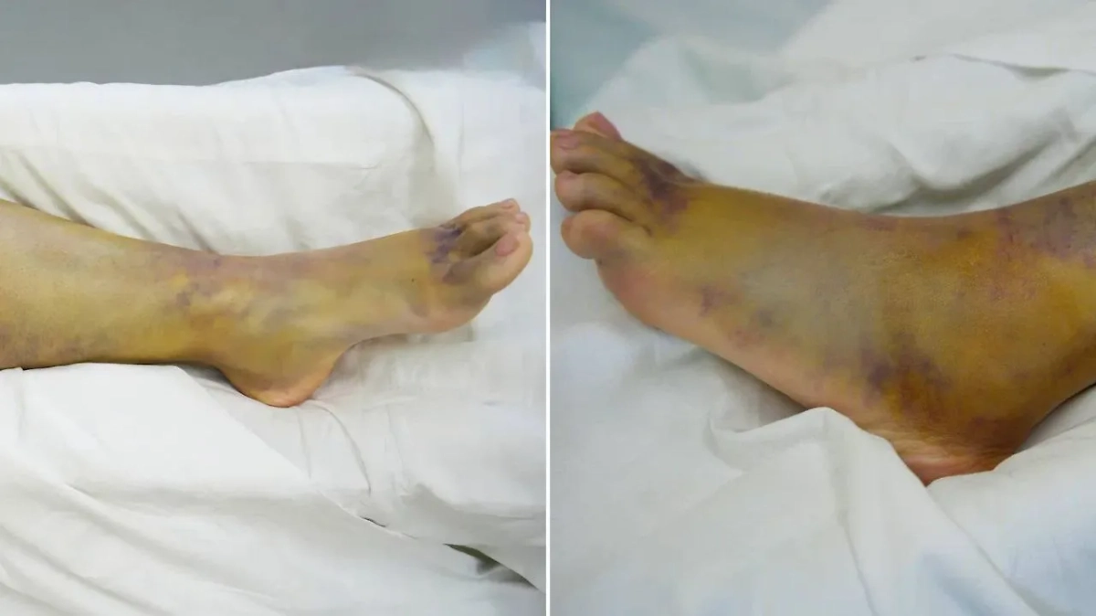 В Склифе в разгар сезона активности гадюк показали, как выглядят пациенты после укусов. Фото © VK / НИИ СП им. Н.В. Склифосовского