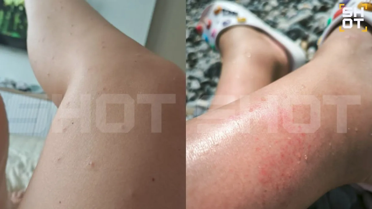 Аллергия на морскую воду у россиян. Фото © Telegram / SHOT