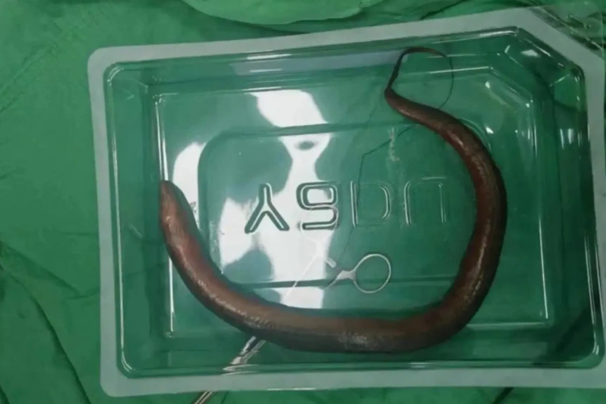 30-сантиметровый угорь, которого удалили из брюшной полости китайца. Обложка © Х / Rod Ryan Show