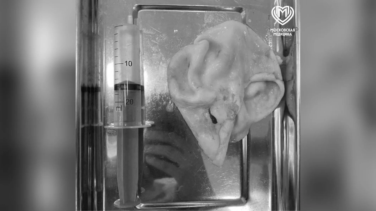 Новообразование. Фото © Telegram / Московская медицина