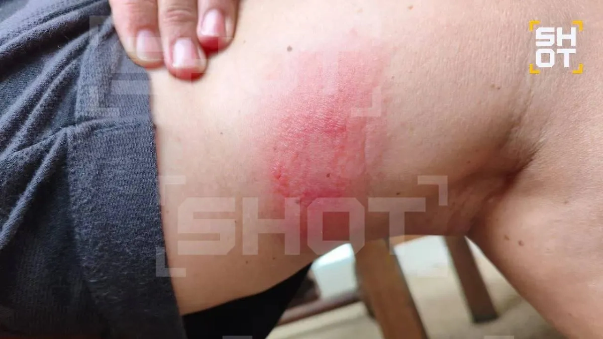 Сначала Светлана не придала укусу значение. Фото © SHOT