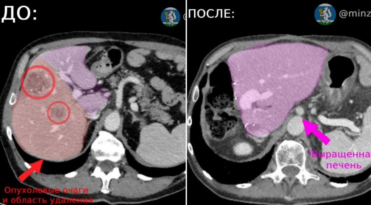Печень пациента. Фото © VK /  Минздрав Свердловской области