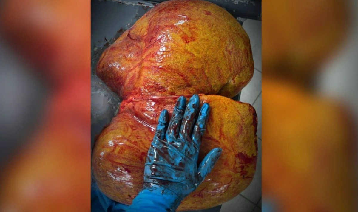 Печень при алкогольной зависимости. Фото © пресс-служба городской клинической больницы №4 во Владивостоке