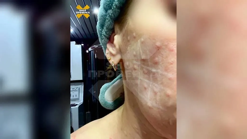 Последствия домашних уколов «сывороткой молодости». Фото © SHOT ПРОВЕРКА
