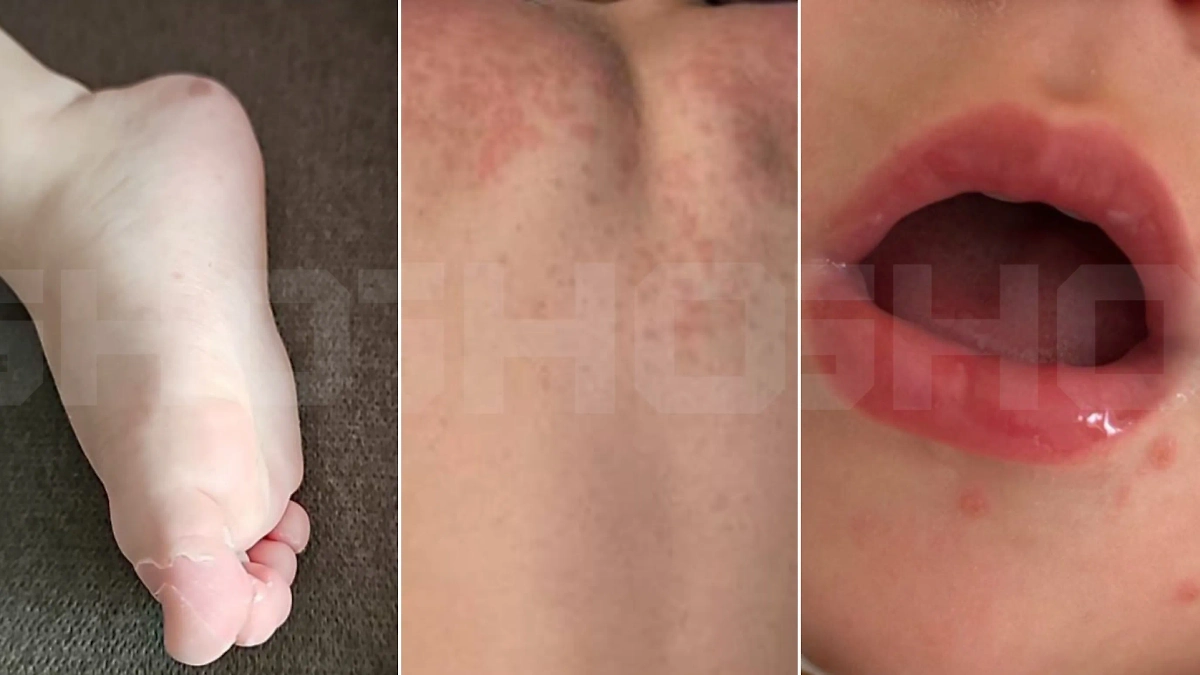 Туристы покрылись характерной для вируса сыпью. Фото © SHOT