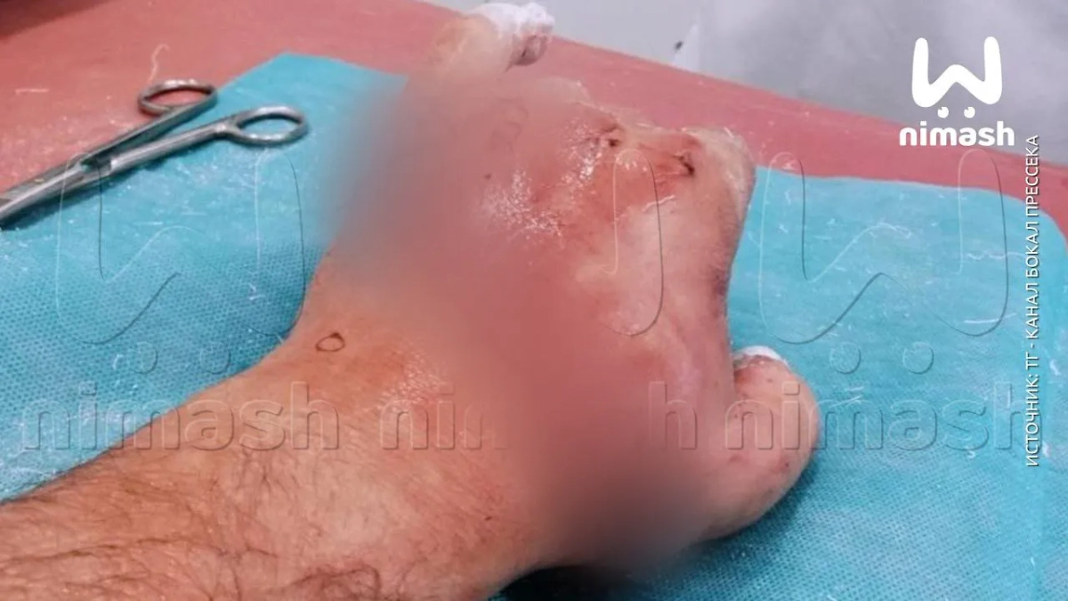 Отрубленная кисть. Фото © Telegram / Ni Mash