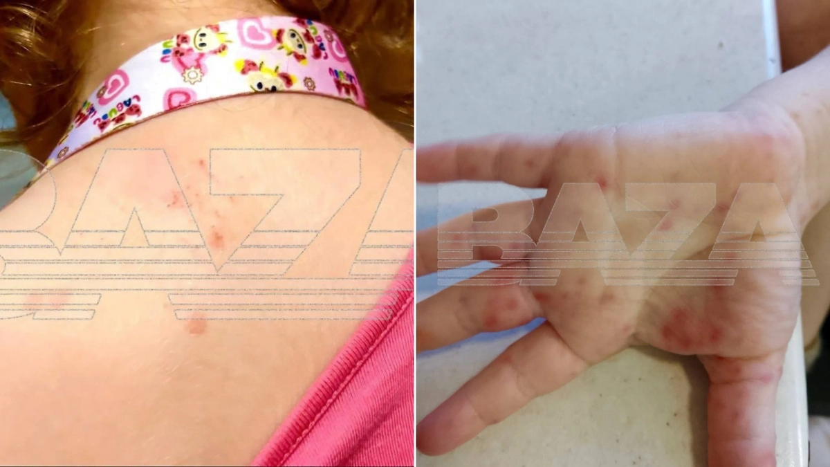 Сыпь у детей. Фото © Telegram / Baza