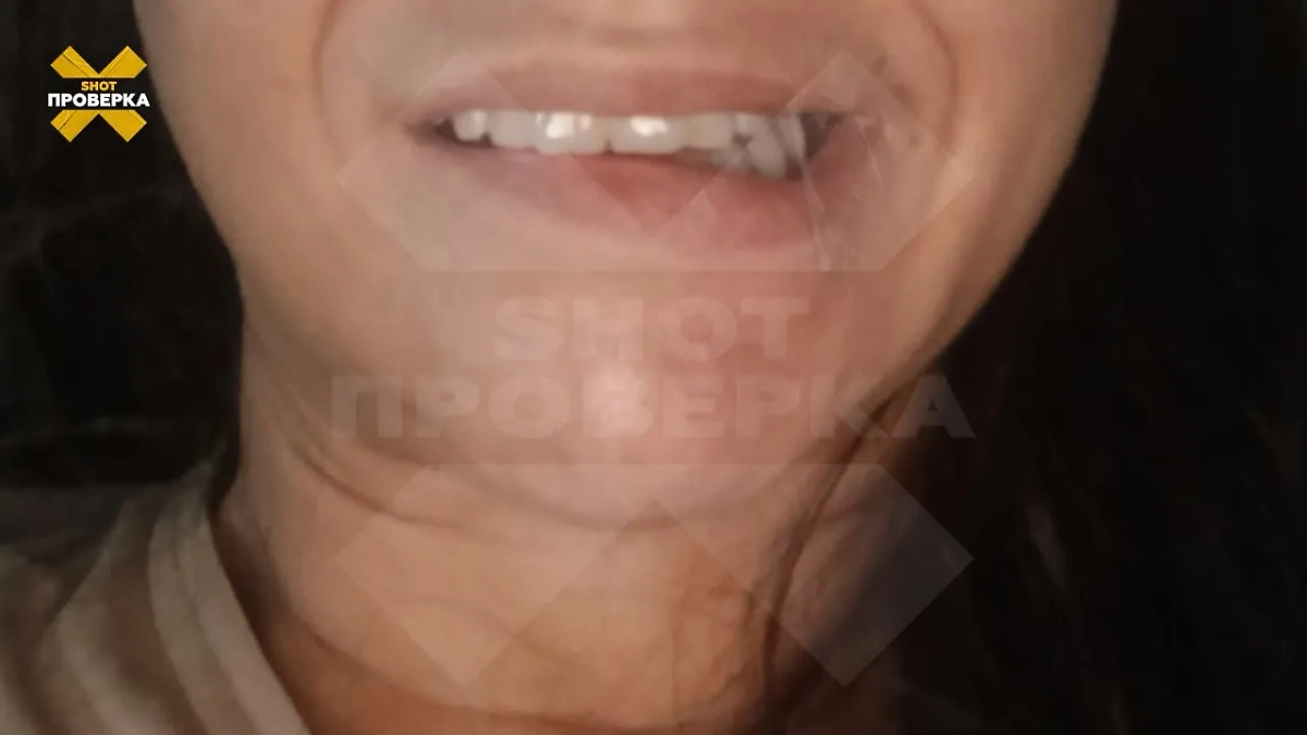 Россиянке перекосило рот после процедуры у косметолога. Фото © Telegram / SHOT ПРОВЕРКА