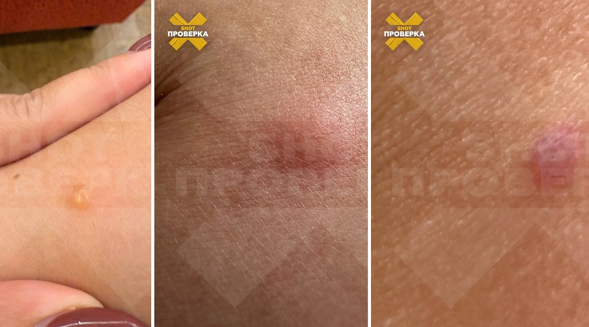 Укусы по всему телу появляются после дневного купания. Фото © Telegram / SHOT ПРОВЕРКА