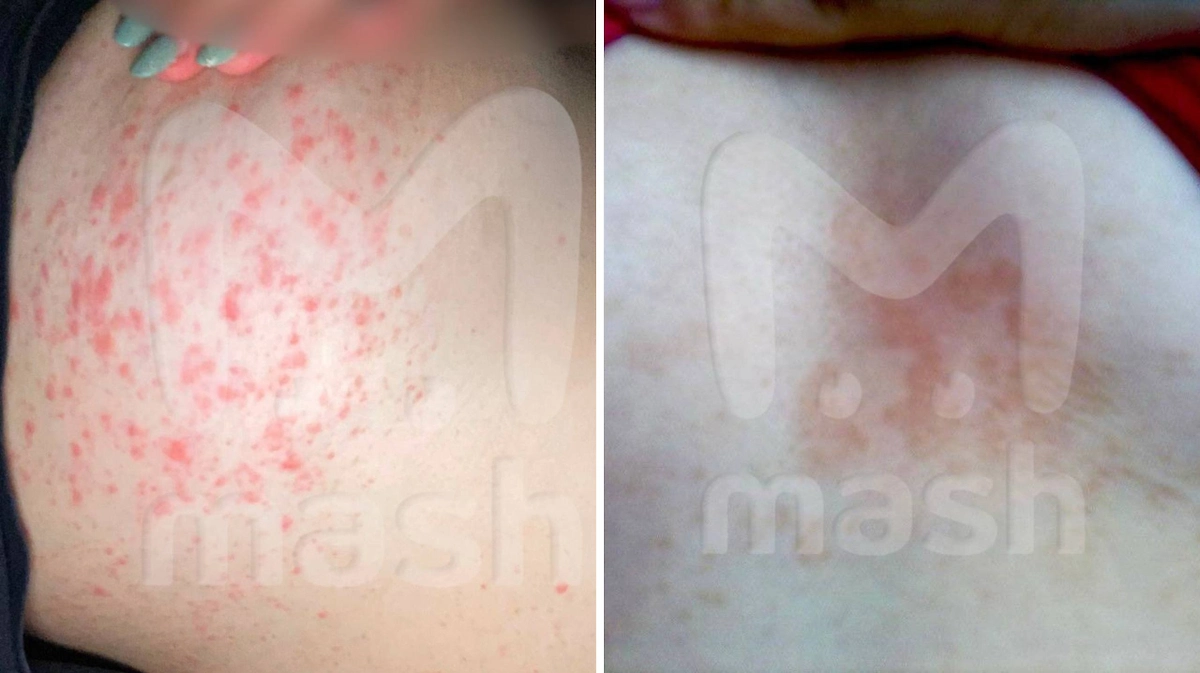 Последствия использования китайского крема. Фото © Telegram / Mash