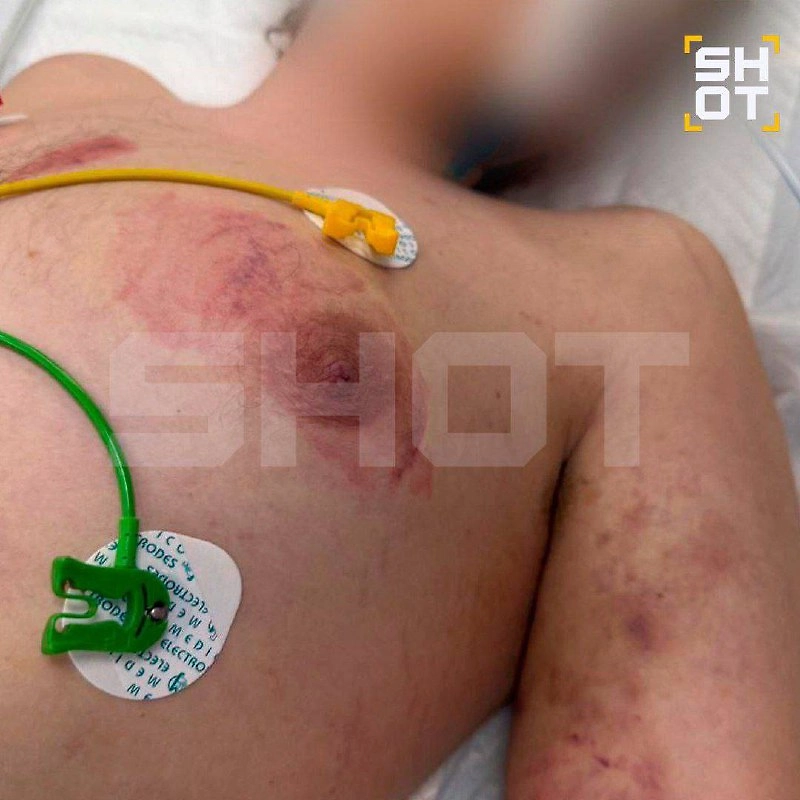 Подросток впал в кому после пыток в рехабе. Фото © Telegram / SHOT