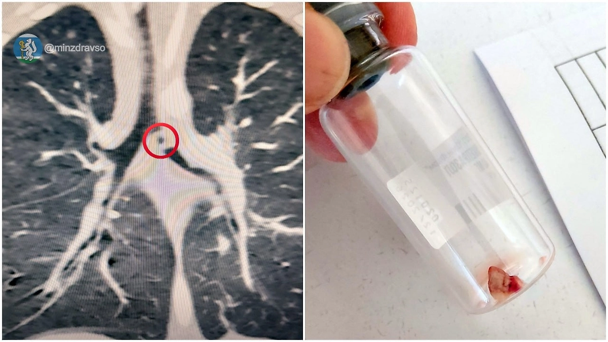 Годовалый мальчик проглотил кусок глины от печки. Фото © VK/ Минздрав Свердловской области 