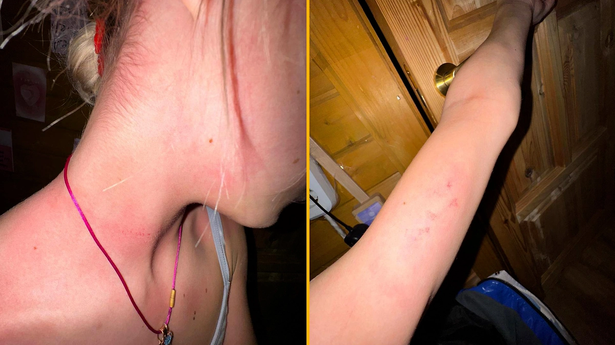 Следы побоев у юной фигуристки Елены Костылевой после избиения собственной матерью. Фото © Telegram / Голубь Мира Яна Рудковская