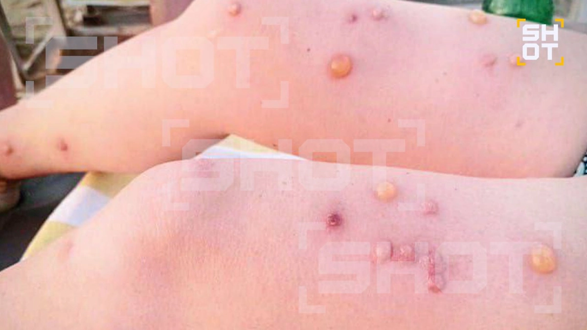 Россияне на Гоа сталкиваются с жуткими последствиями укусов тигровых комаров. Фото © SHOT