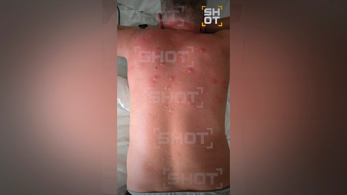 Россияне на Гоа сталкиваются с жуткими последствиями укусов тигровых комаров. Фото © SHOT