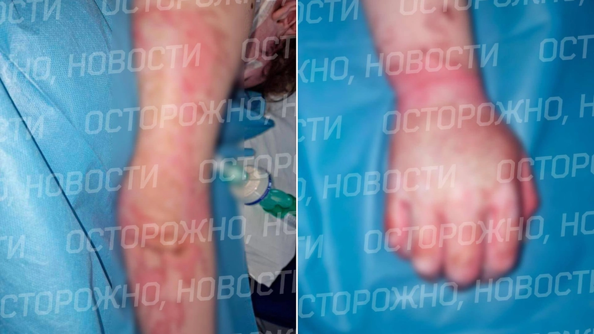 Девушку увезли в больницу с ожогами второй и третьей степени на более чем 40% тела. Фото © Telegram / Осторожно, новости