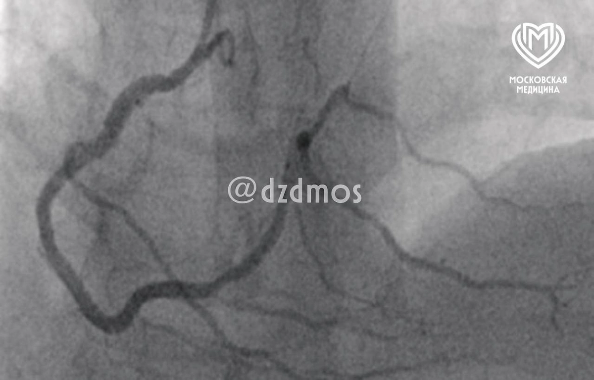 Кусок свинины вызвал у мужчины аллергический инфаркт. Фото © Telegram / Московская медицина 