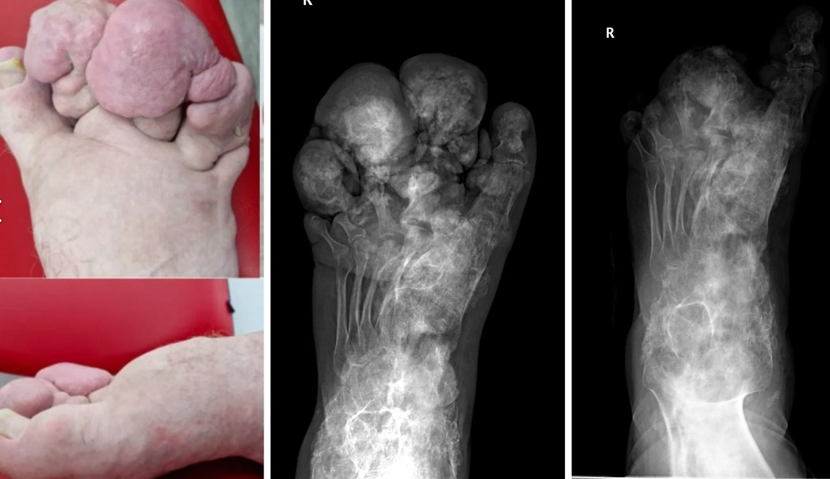 В России спасли пациента, который страдал синдромом Протея. Обложка © ННИИТО имени Цивьяна