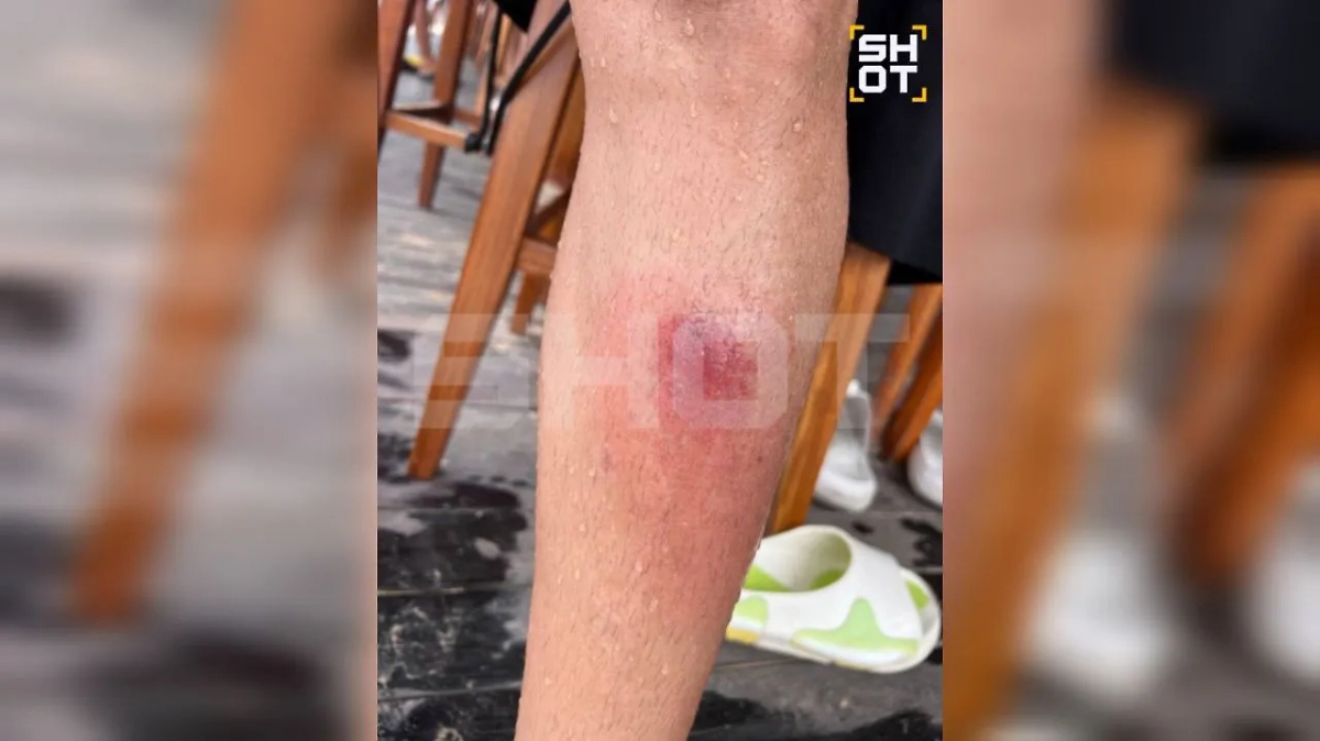 У некоторых пострадавших распухают и отнимаются ноги. Фото © SHOT