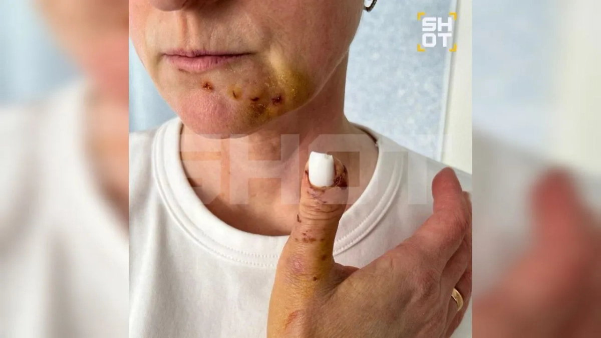 Соседская собака покусала лицо и руки Ирины. Фото © SHOT