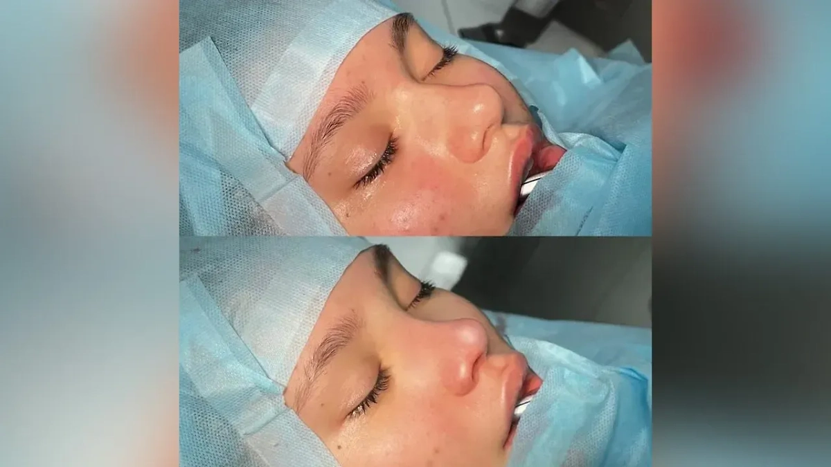 Полина Аксёнова в ходе ринопластики. Фото © Instagram (соцсеть запрещена в РФ; принадлежит корпорации Meta, которая признана в РФ экстремистской) / babayanplastic