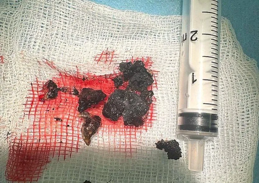 Уголь из носа. Фото © Предоставлено Life.ru 