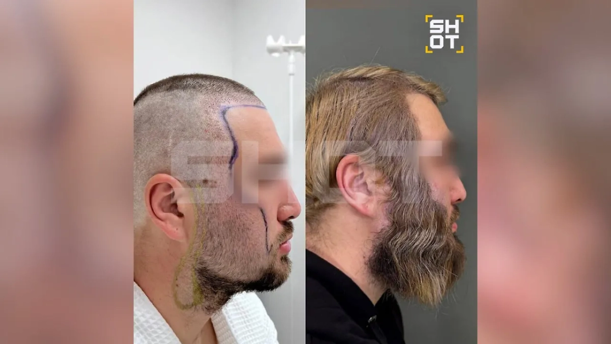 Результат пересадки бороды и бакенбард. Фото © SHOT