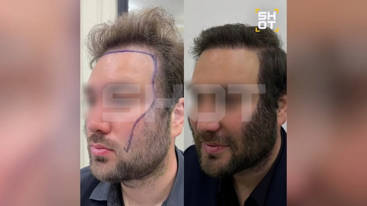 Результат пересадки бороды и бакенбард. Фото © SHOT