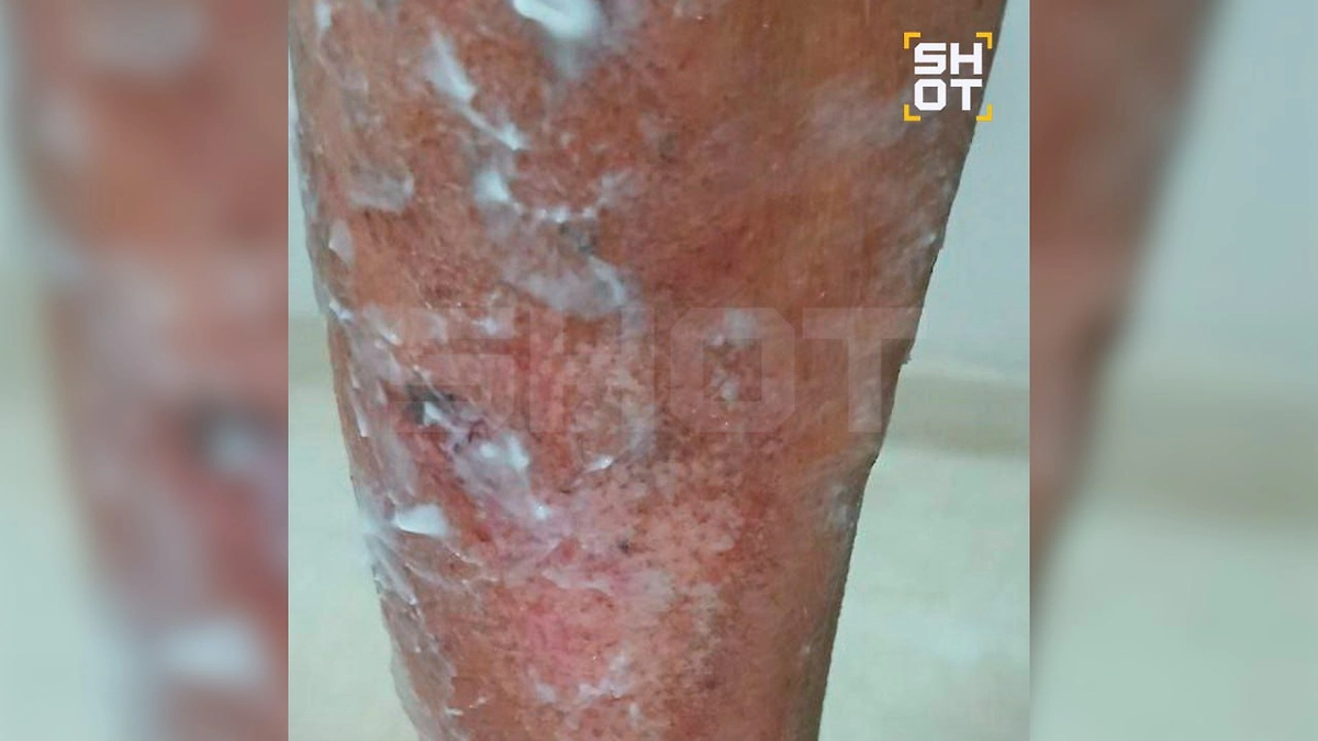 Травмы, оставленные бандитами. Видео © Telegram / SHOT