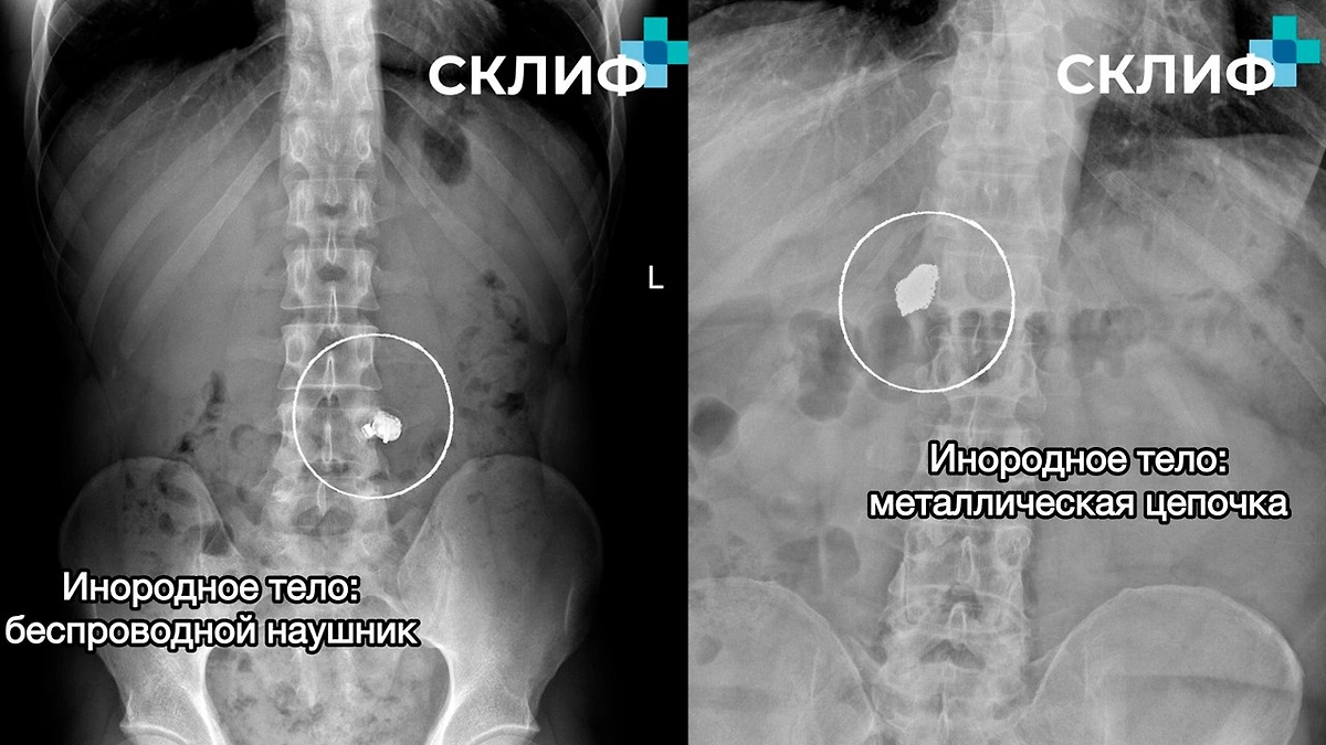 Извлечённые предметы из пациентов НИИ скорой помощи имени Н. В. Склифосовского. Фото © Telegram / Склиф
