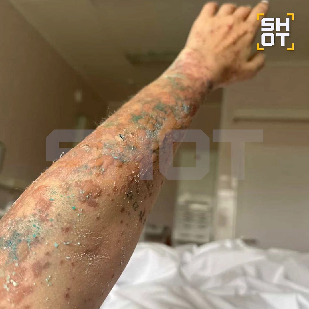 Девушке диагностировали Синдром Лайела — редкое и очень тяжело аллергическое заболевание, ставшее следствием приëма ламотриджина. Фото © Telegram / SHOT