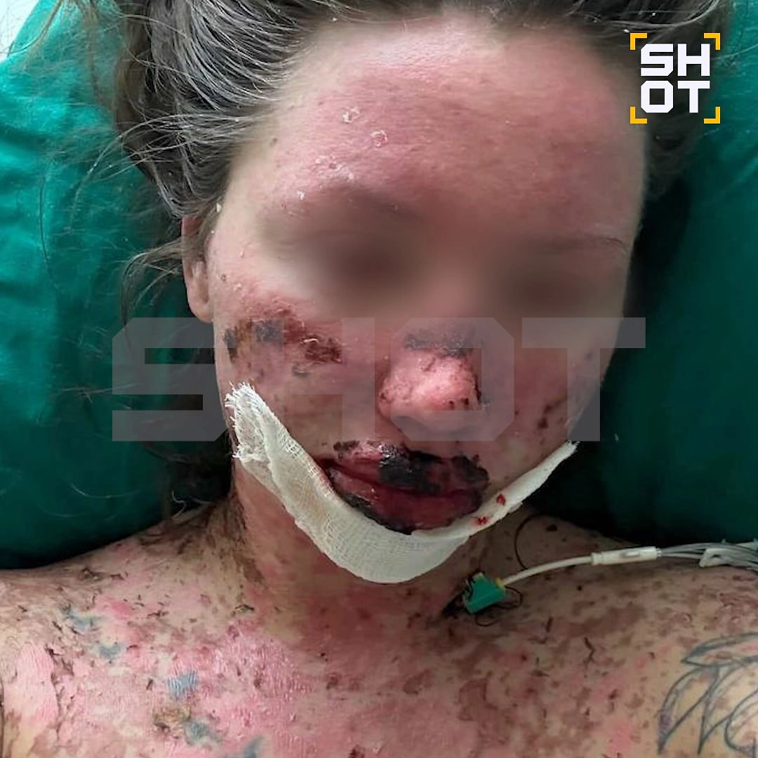 Девушке диагностировали Синдром Лайела — редкое и очень тяжело аллергическое заболевание, ставшее следствием приëма ламотриджина. Фото © Telegram / SHOT