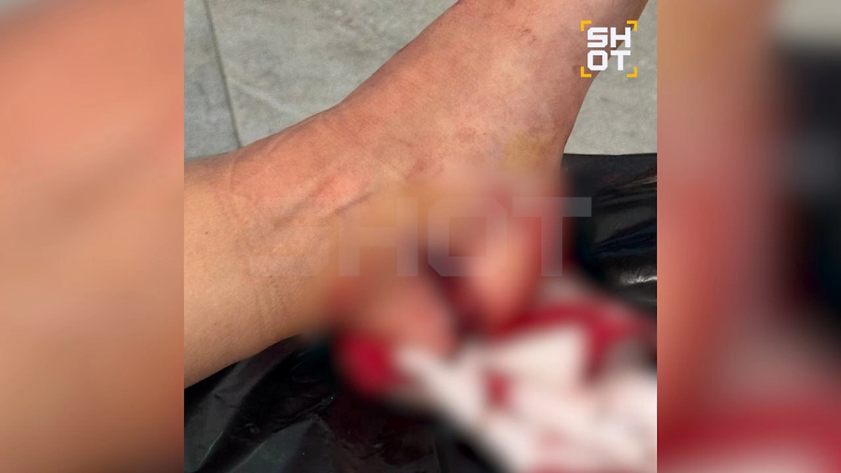 Нога пострадавшей в Танзании россиянки. Фото @ SHOT