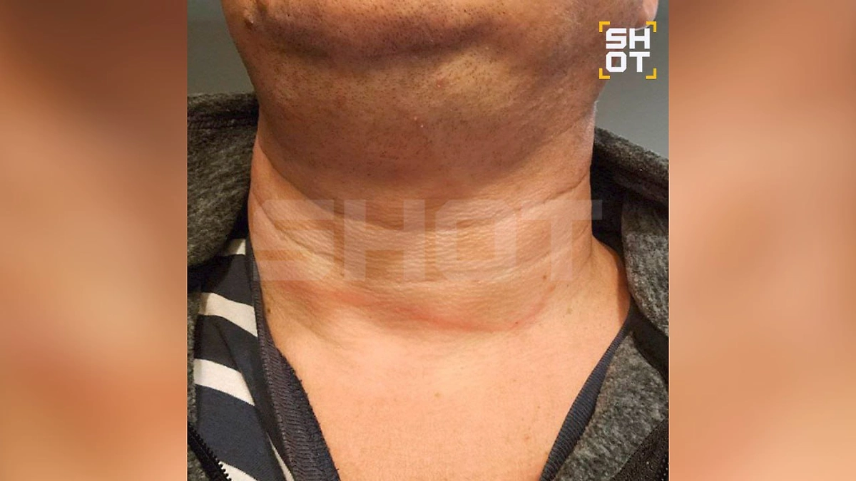 След от верёвки на шее туриста из РФ. Фото © Telegram /SHOT