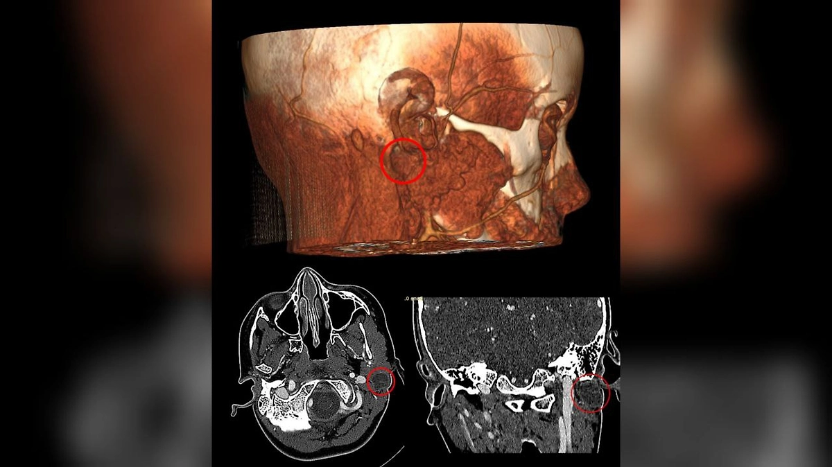 Врачи успешно удалили редчайшую кисту у ребёнка, сохранив мимику лица. Фото © VK / Российская детская клиническая больница (РДКБ)