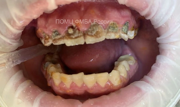 Зубы любителя энергетиков из Нижнего Новгорода до обращения к врачам. Фото @ Telegram / «Бокал Прессека»