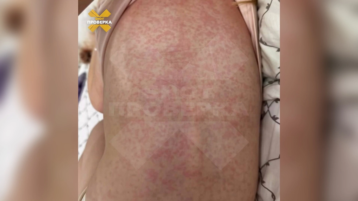 У ребёнка появились выспыпания после шоколада. Фото © Telegram/ SHOT ПРОВЕРКА